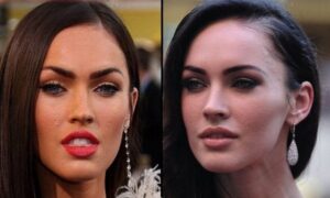 Even the most beautiful people suffer from Acne Scars.